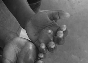 Police On The Hunt For Mother Over Burning 4 Year Old Daughter With Hot Water For Eating Rice Without Permission