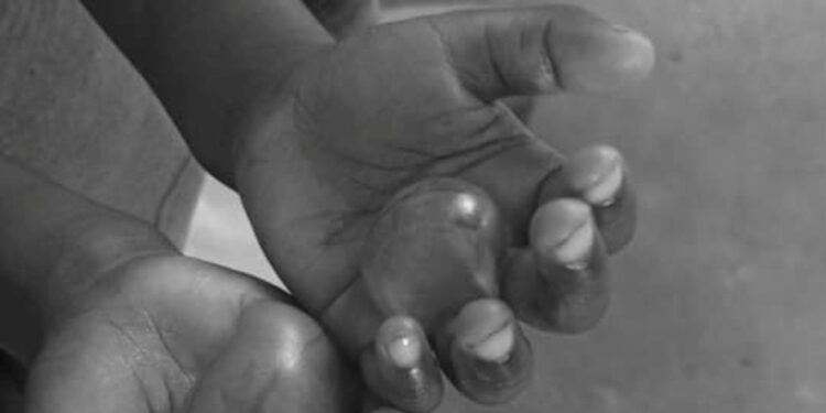 Police Hunting For Mother Over Burning 4 Year Old Daughter With Hot Water For Eating Rice Without Permission